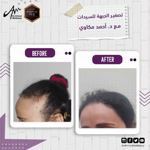 قبل وبعد زراعة الشعر